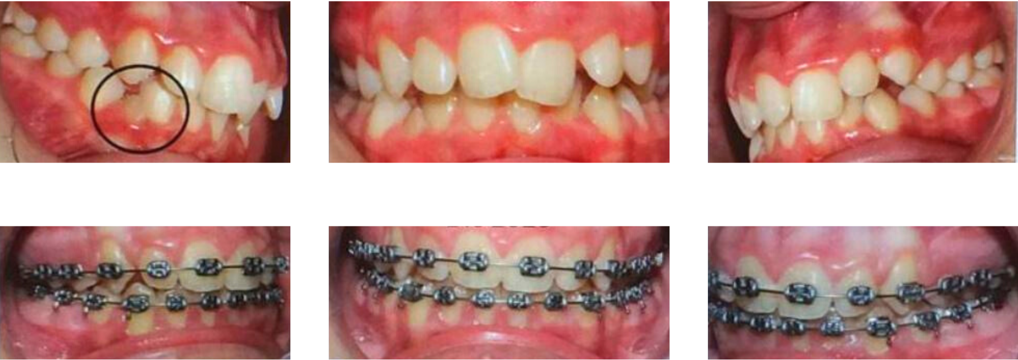 Evolución tratamiento ortodoncia en adolescente