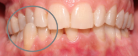Tratamiento ortodoncia multidisciplinar en adultos