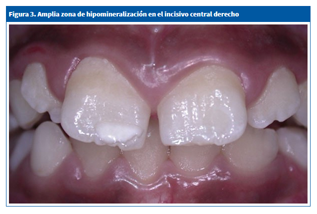 Hipomineralización en incisivo molar derecho