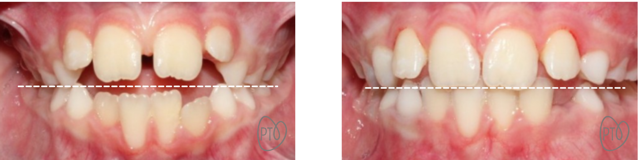 ortodoncia interceptiva tratamiento mordida abierta